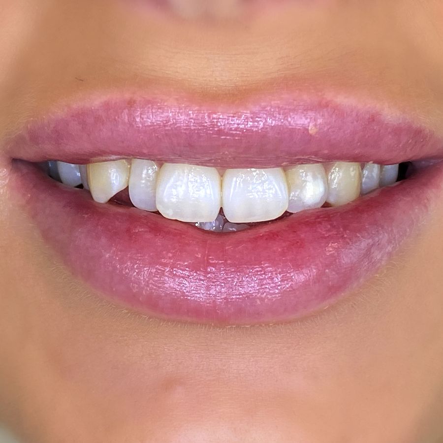 Composite bonding - before - 3Dental - Dublin & Limerick